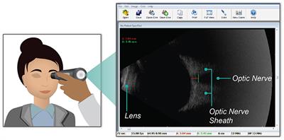 Using Oculomotor Features to Predict Changes in Optic Nerve Sheath Diameter and ImPACT Scores From Contact-Sport Athletes